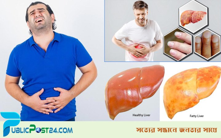 ফ্যাটি লিভারের ৪ লক্ষণ জেনে নিন