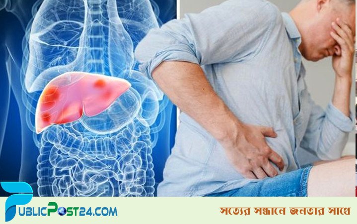লিভার সিরোসিসের কারণে হঠাৎ ভুঁড়ি বেড়ে যায়