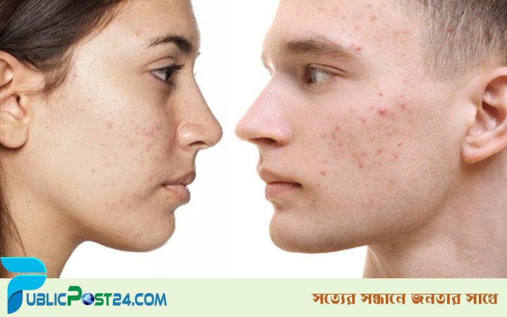 দূর করুন ব্রণের কালো দাগ