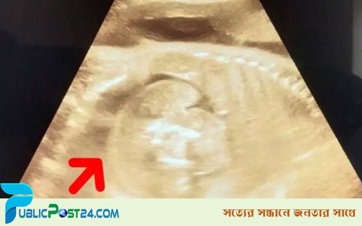 গর্ভে থাকা শিশুর গর্ভে মিলল ভ্রূণ